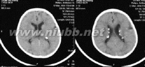 结节性硬化症：结节性硬化症-病因，结节性硬化症-临床表现_结节性硬化症